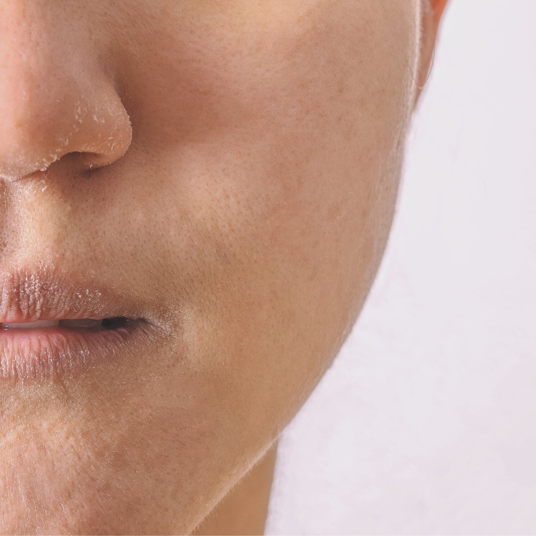 Tips to Soothe Dry Skin in the Winter - Koope